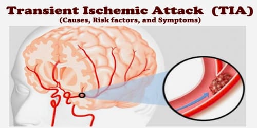 Understanding Transient Ischemic Attack Tia Or Mini Stroke